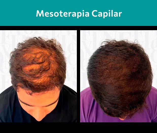 Transplante Capilar em Ribeirão Preto6